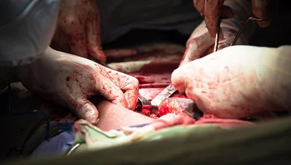 CESAREAN SECTION 